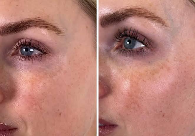 ICONA H8 Skin Booster treatment at Remedi Medispa